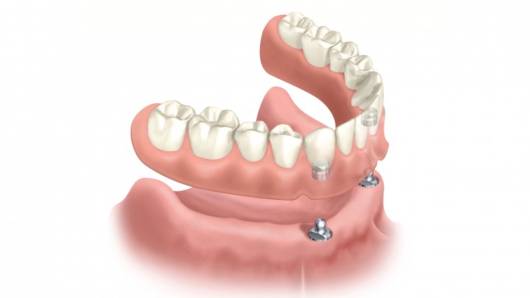 Como segurar a prótese dentária inferior