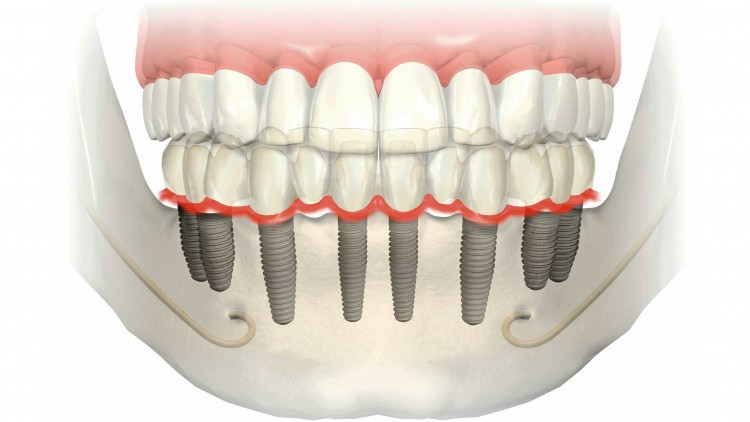 Implantes Dentários (Parte II)